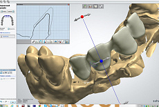 CAD/CAM системы в стоматологии